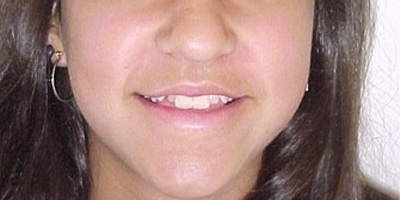 antes