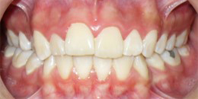 antes 13 2